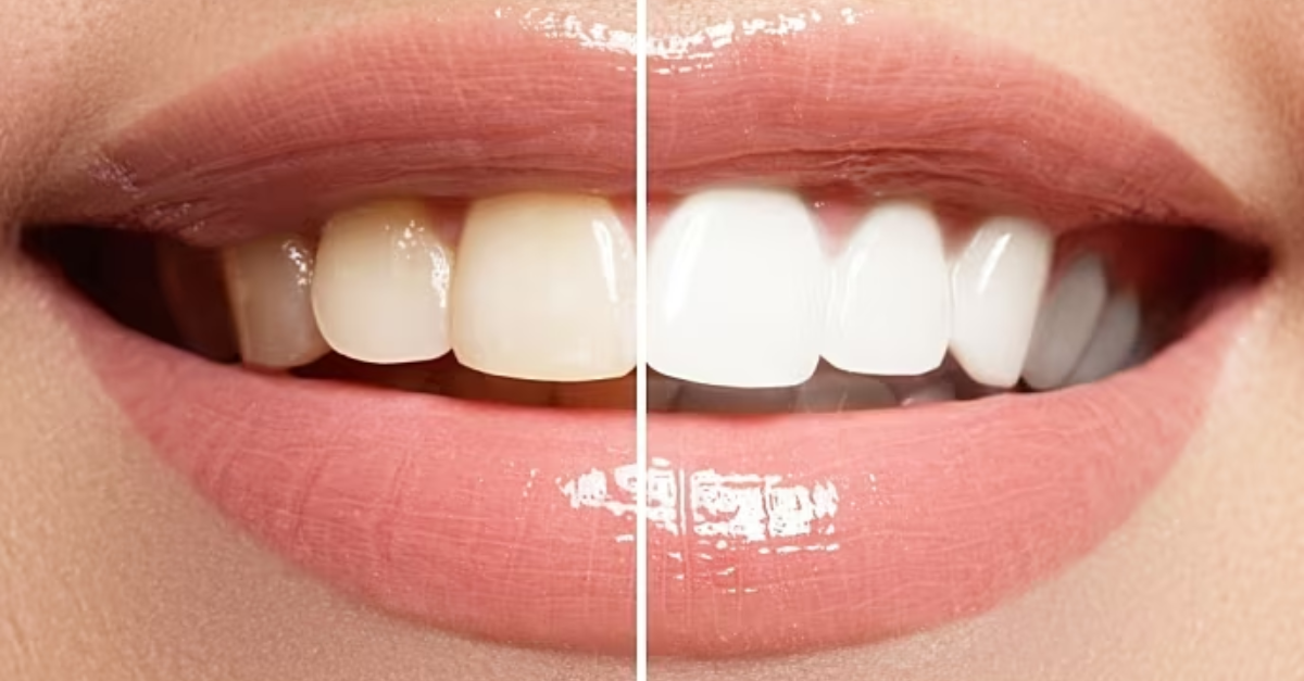Teeth Whitening Options Professional vs. At Home Treatments